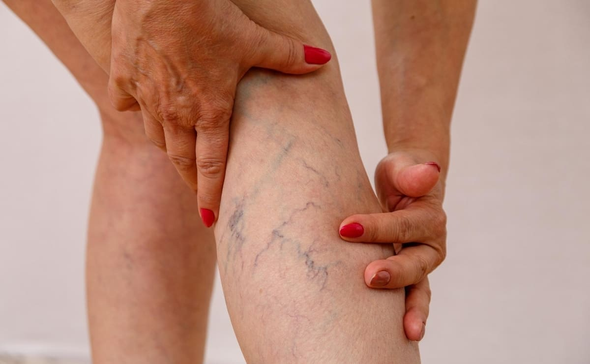 Los mejores métodos para combatir las varices